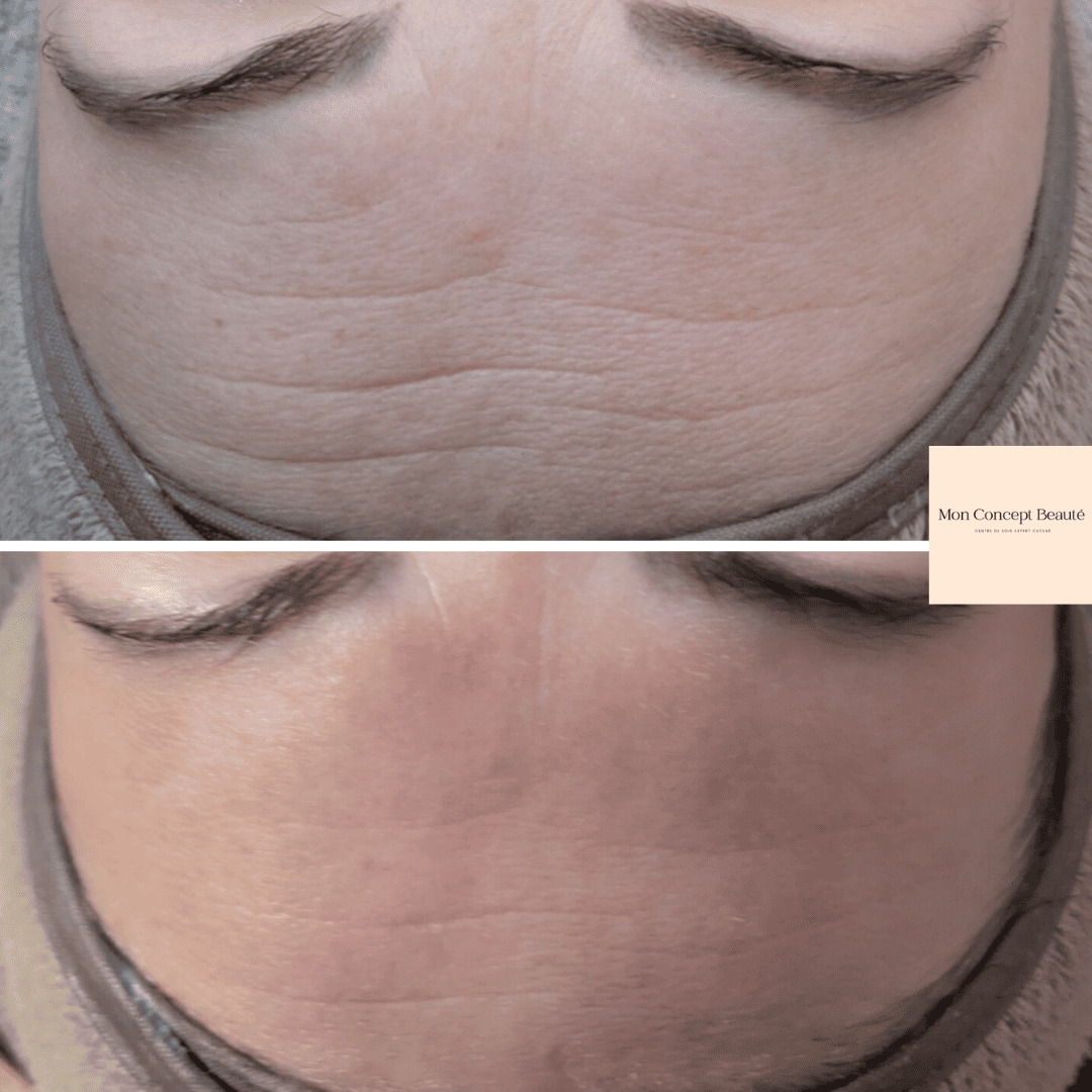 Résultats avant après Mon Concept Beauté