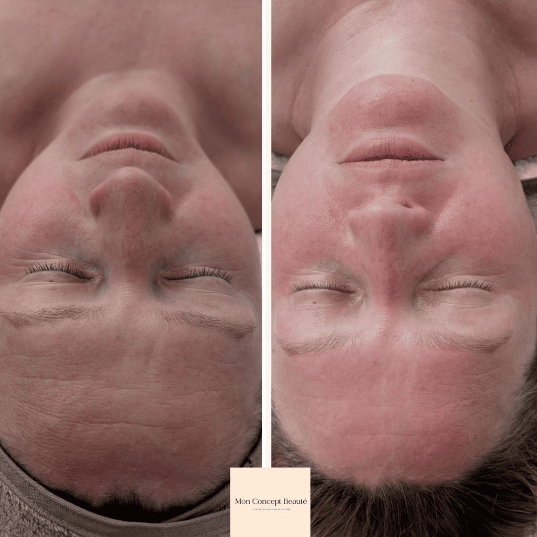Résultats d'un soins chez mon Concept beauté
